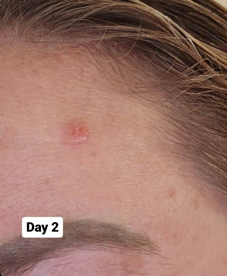Woman with skin lesion aggravated by retinol product