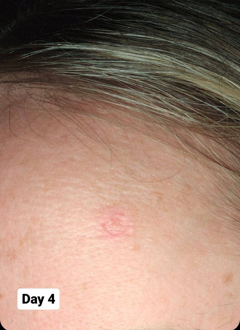 Skin lesion on woman's head
