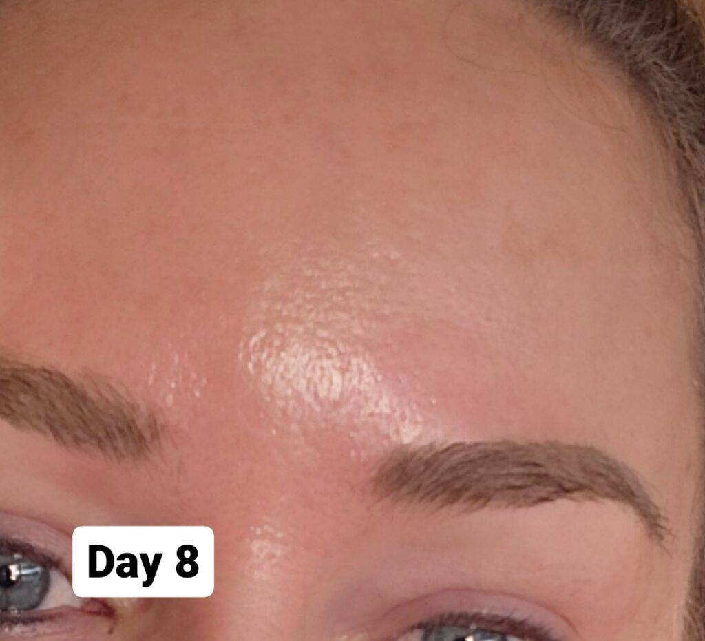 Woman's forehead after retinol treatment.